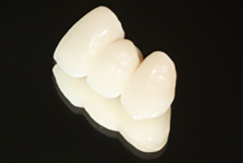 セラミック（インレー・クラウン）