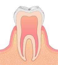 初期のむし歯 CO