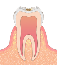 C1 エナメル質のむし歯