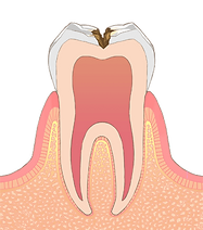 C2 象牙質に達するむし歯