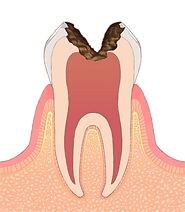 C3 歯髄に達するむし歯