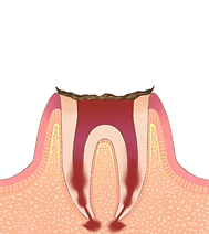 C4 歯根に達するむし歯