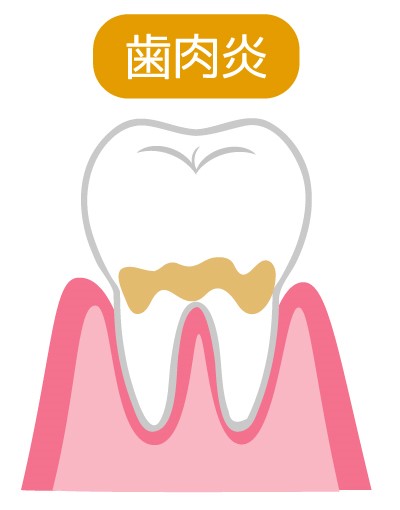 歯肉炎（しにくえん）