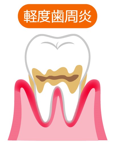 軽度・歯周炎（ししゅうえん）