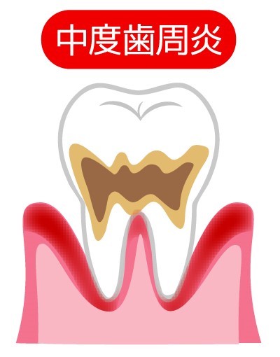 中等度・歯周炎（ししゅうえん）
