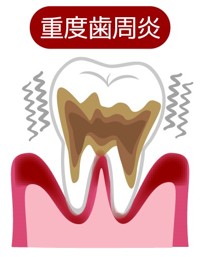 重度・歯周炎（ししゅうえん）